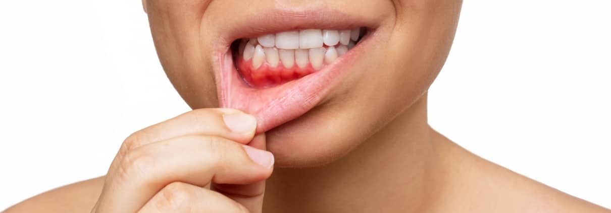 A person pulls down their lower lip with their fingers, revealing gums and teeth against a white background.